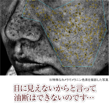 （※特殊なカメラでメラニン色素を撮影した写真）目に見えないからと言って油断はできないのです…」